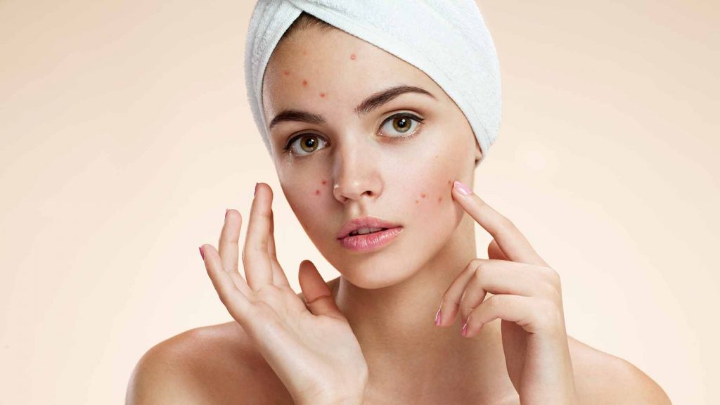 acne natural facial masks diy problem skin