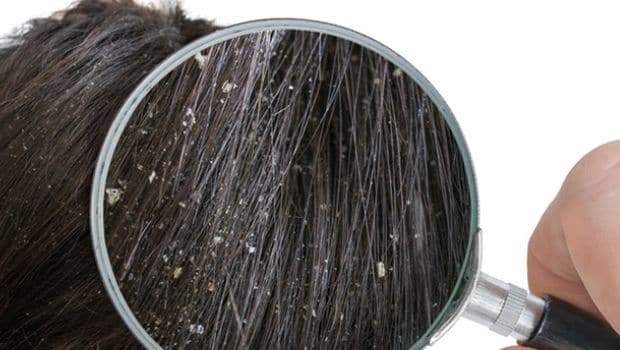 dandruff home remedies healthy hair
